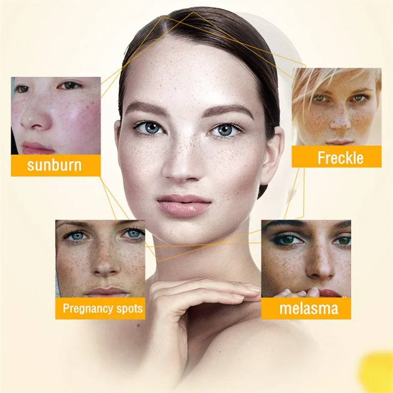 Whitening Freckle Cream Remove - огляд і ціна Skincare Glowing