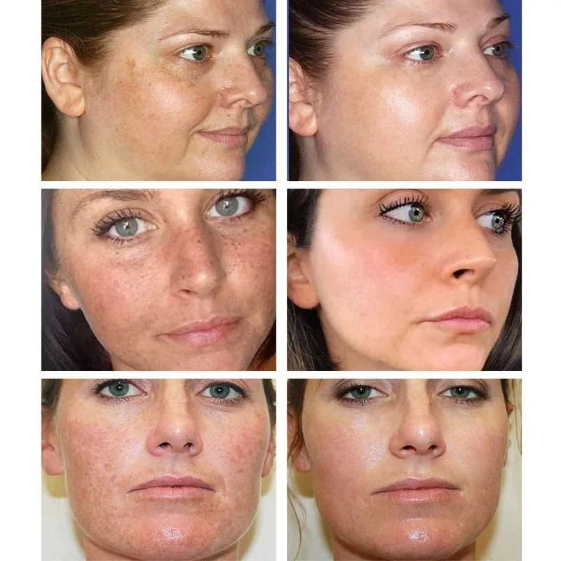 Whitening Freckle Cream Remove - огляд і ціна Skincare Glowing