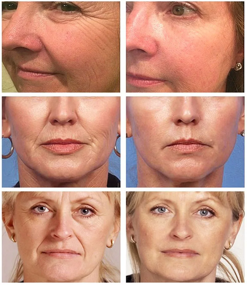 Collagen Wrinkle Remover Face  - огляд і ціна Vitamin C Serum